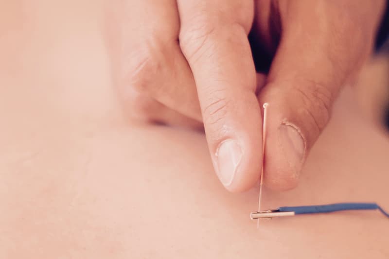 Electroacupuncture in Lleida by Dr. Meler MD